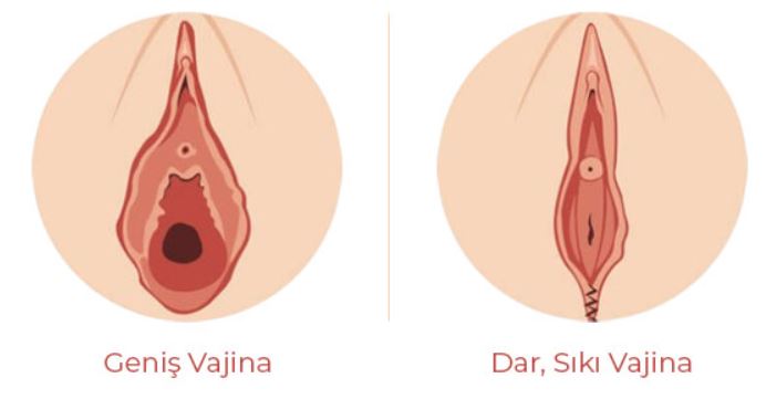 Vajinal Daraltma