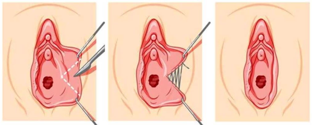 Labioplasti (Genital Dış Dudak Estetiği)