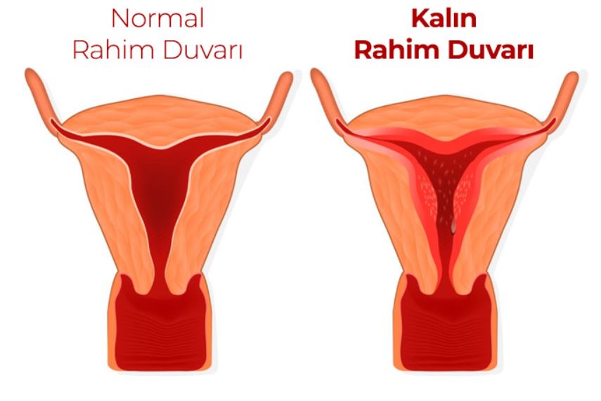 Rahim Duvarı Kalınlaşması ve Tedavisi