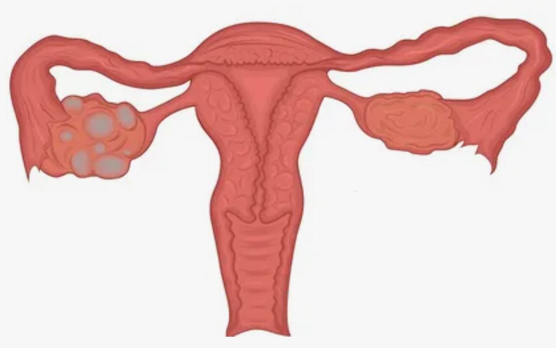 PCO Polikistik Over Sendromu