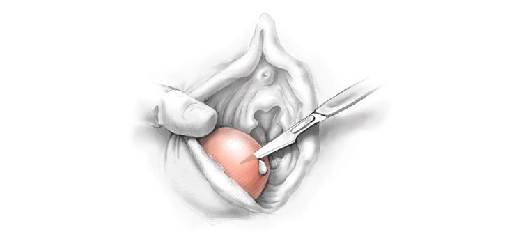 Bartolin Kisti ve Apsesi Tanı ve Tedavi